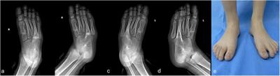 Massive tarsal coalition with extended tarsometatarsal coalition in a child: a case report